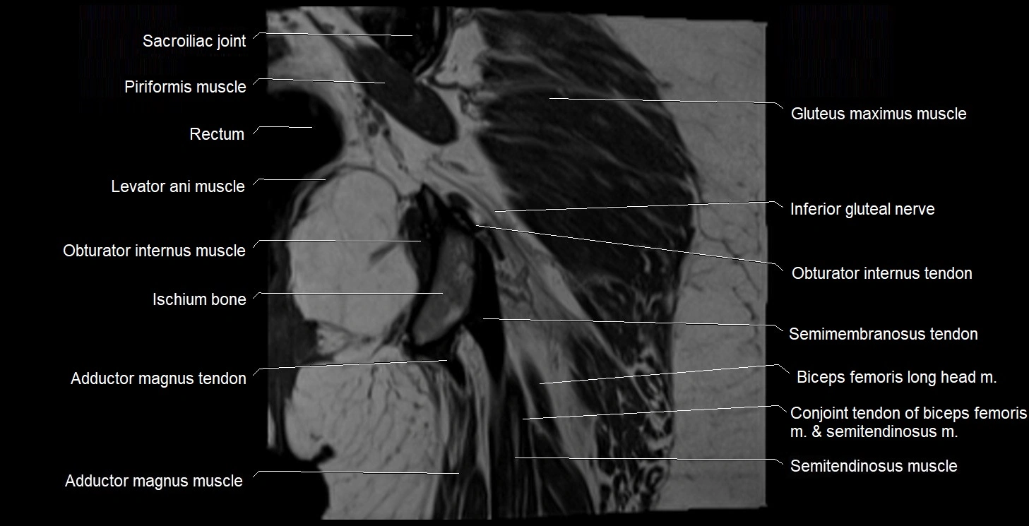 MRI Hip 3T coronal cross sectional anatomy image 52.webp